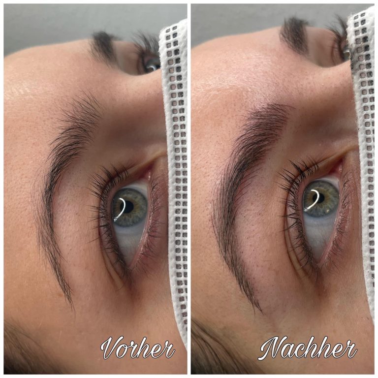 vorhar-nachher-brow-lifting