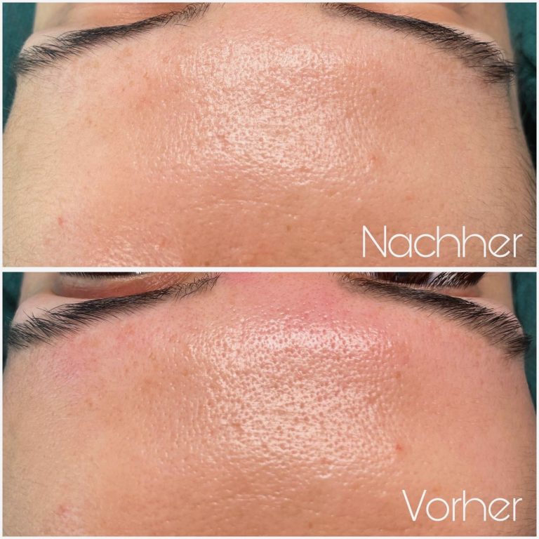 vorher-nachher-haut-2