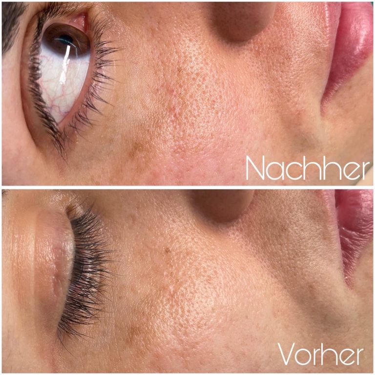 vorher-nachher-haut-3