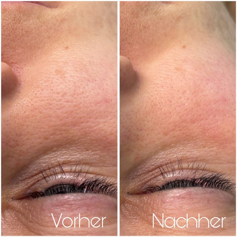 vorher-nachher-haut