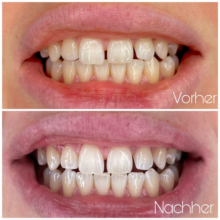 vorher-nachher-zahnbleaching-1