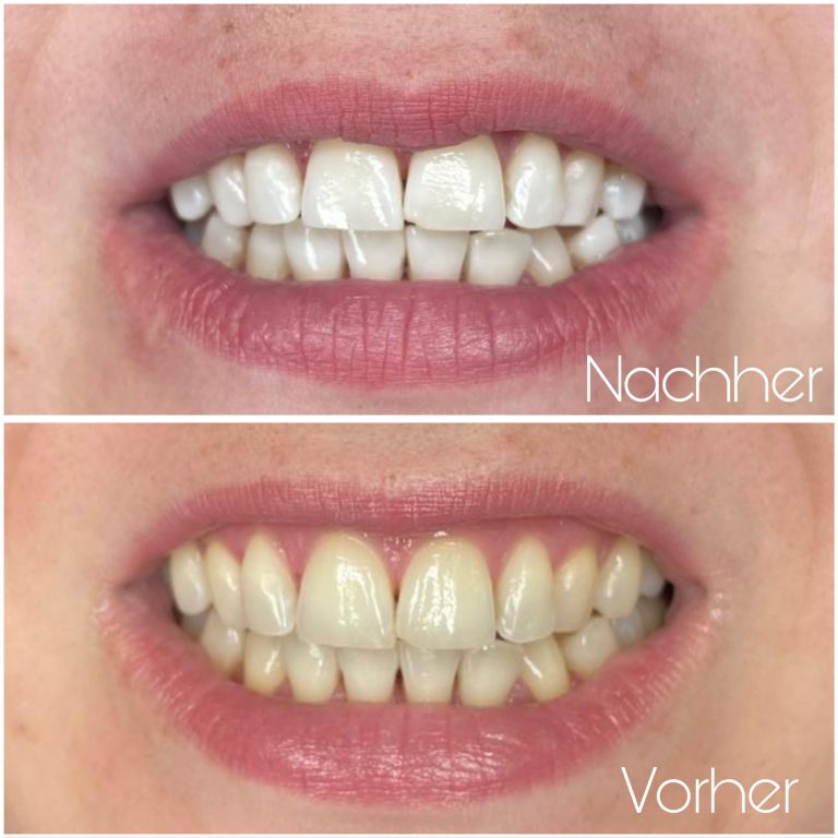 vorher-nachher-zahnbleaching-3