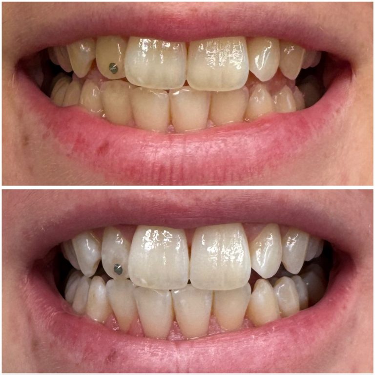 vorher-nachher-zahnbleaching