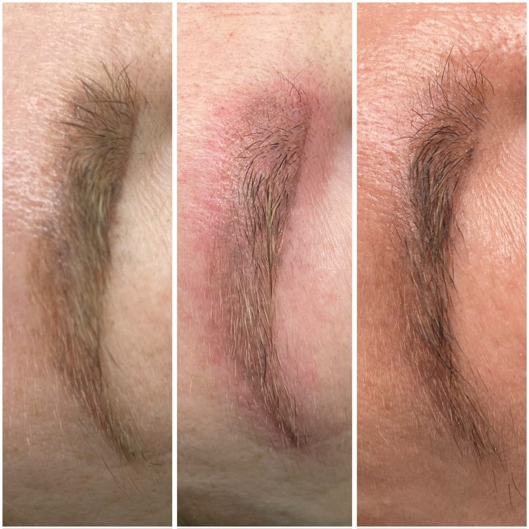 permanent-makeup-removal-1