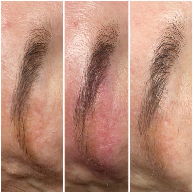 permanent-makeup-removal-2