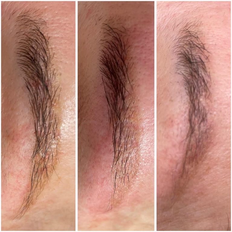 permanent-makeup-removal-3